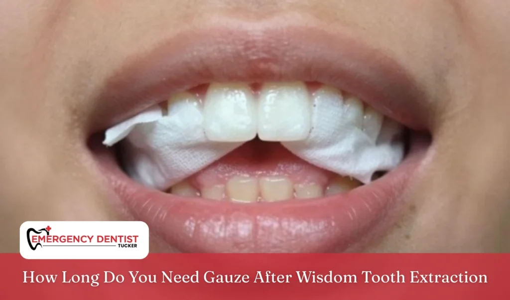 How Long Do You Need Gauze After Wisdom Tooth Extraction
