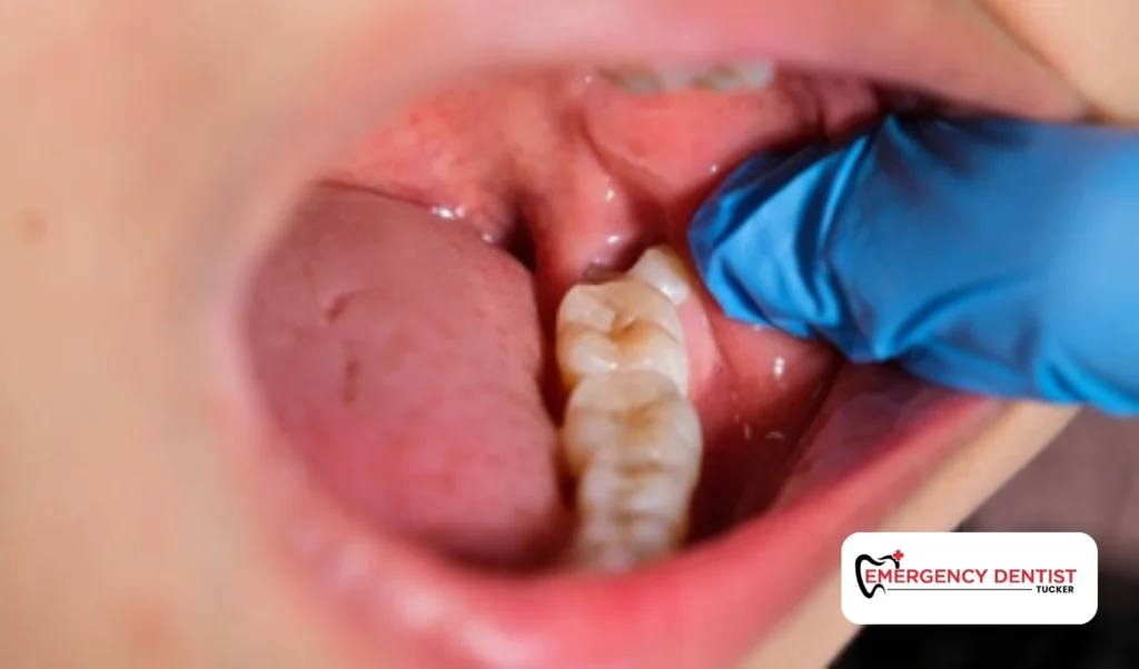 The First 24 Hours After Wisdom Tooth Removal