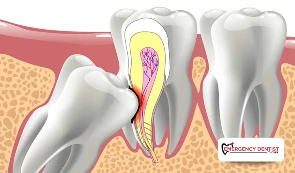 Why Wisdom Tooth Removal May Be Necessary
