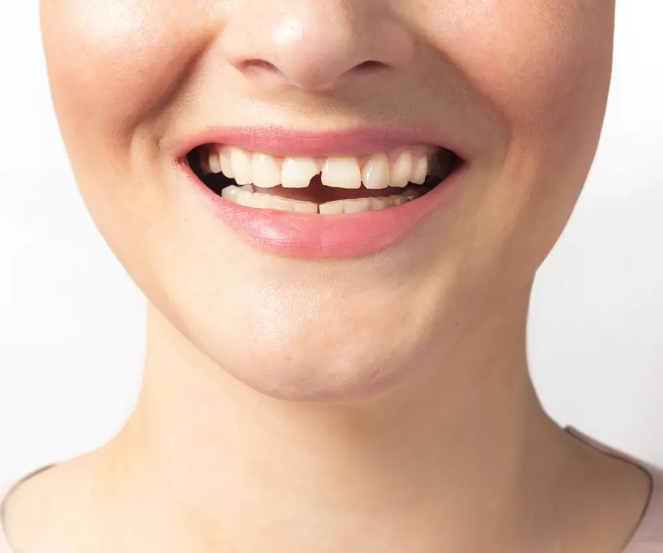 Cracked-or-Broken-Teeth-Tucker-GA