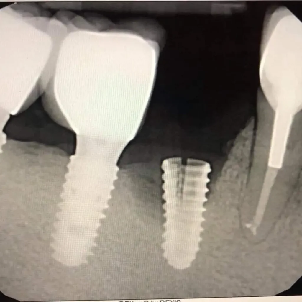 Cracked-or-fractured-implants-Tucker-GA
