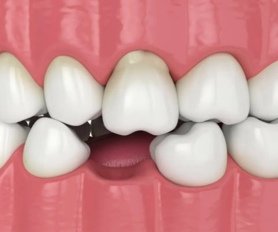 Dislocated-Teeth-Tucker-GA