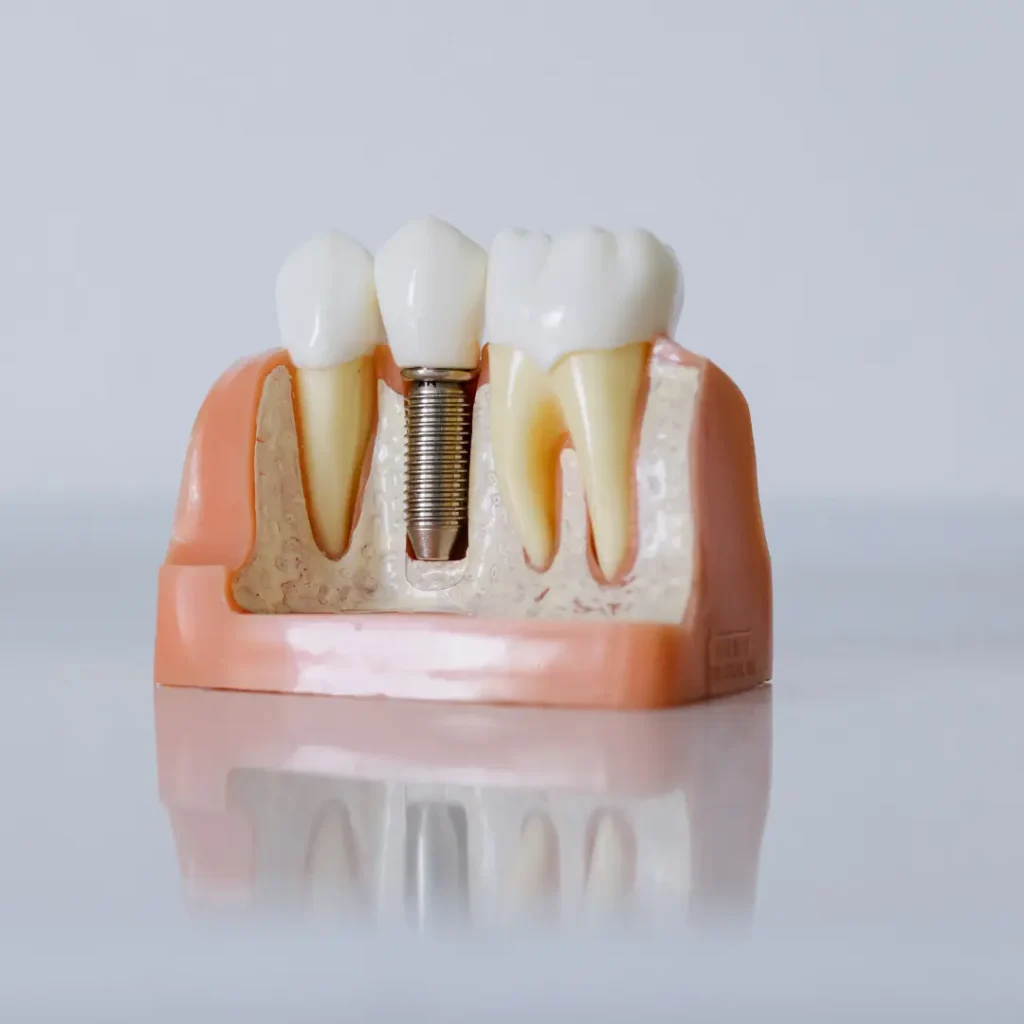 Emergency-Dental-Implant-Tucker-GA