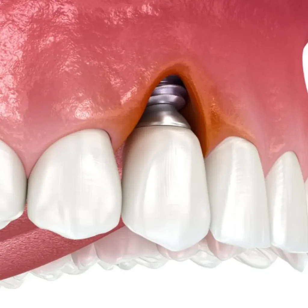Infection-or-pain-around-an-implant-Tucker-GA