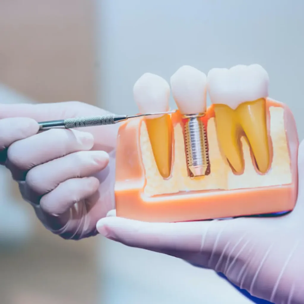 Loose-or-shifting-dental-implants-Tucker-GA
