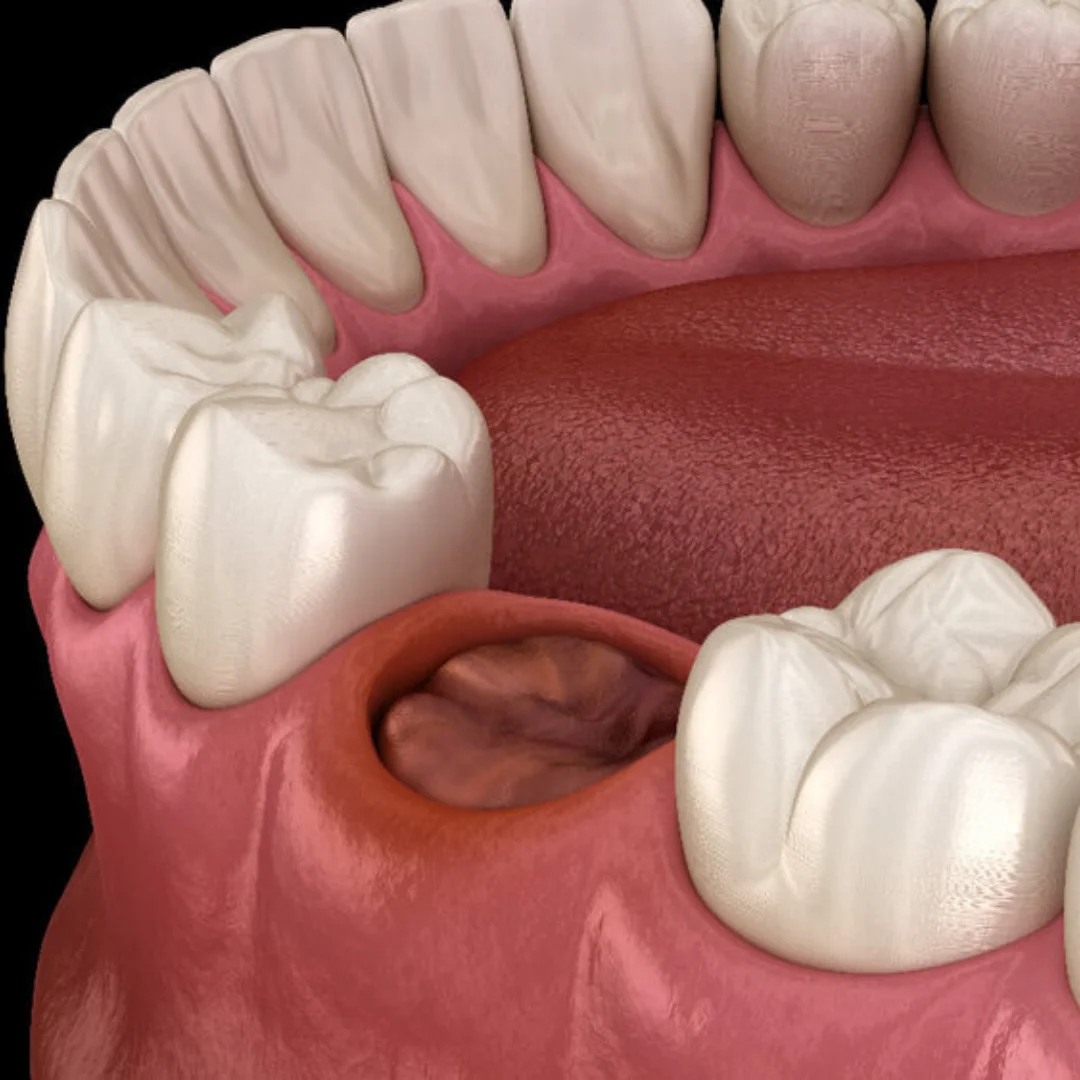 Symptoms-of-Dry-Socket-Tucker-GA