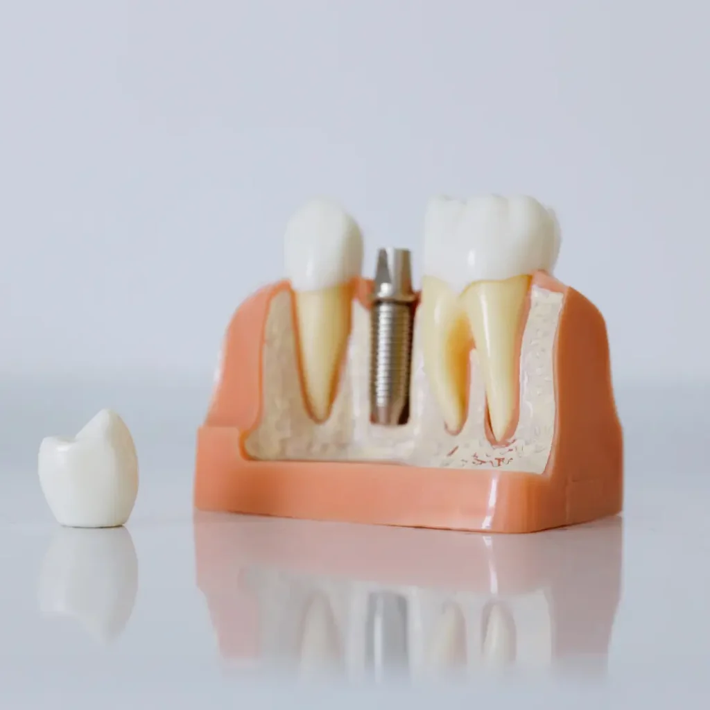 The-implant-crown-fell-off-or-broke-Tucker-GA