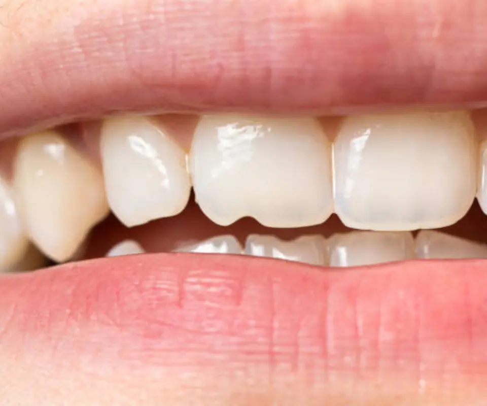 Tooth-Fractures-Tucker-GA