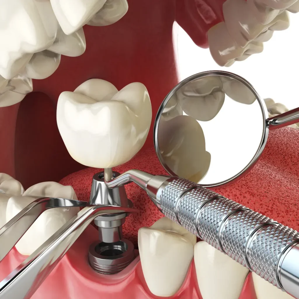 Trauma-related-tooth-loss-needs-immediate-implants-Tucker-GA