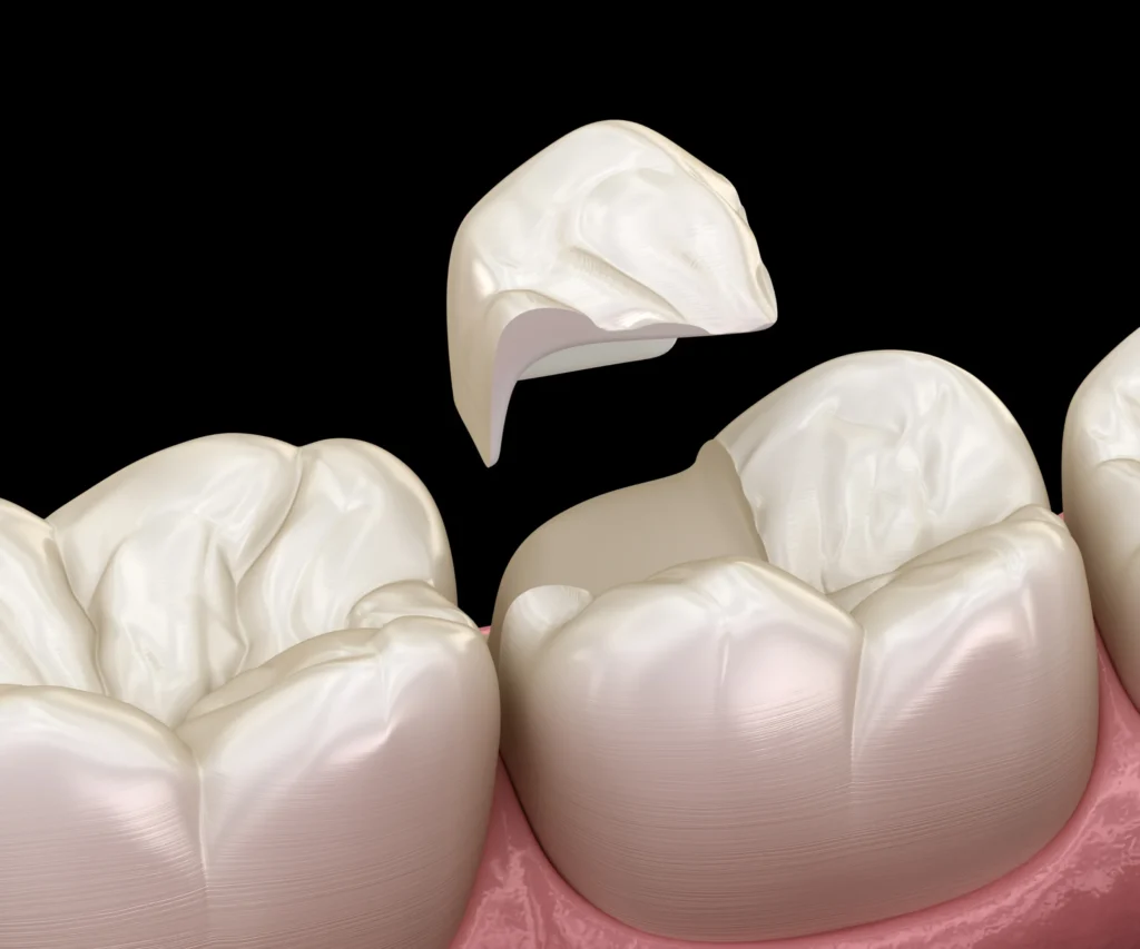 What-Causes-a-Cracked-Tooth-Tucker-GA