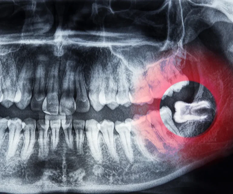 Wisdom-Tooth-Infection-Emergencies-Tucker-GA