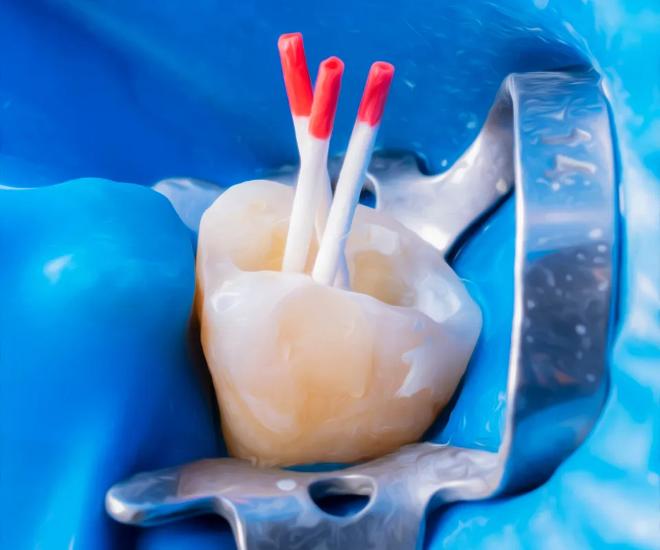 Root-Canal-Treatment-Process-Tucker-GA