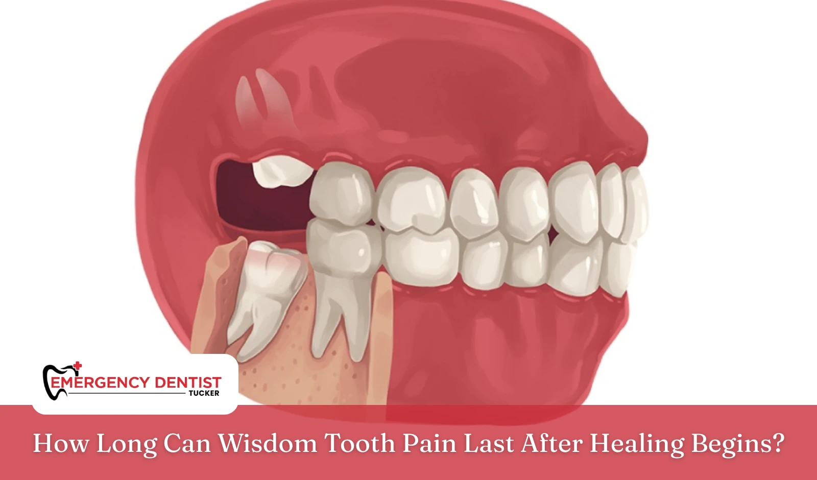 how-long-wisdom-tooth-pain-last-healing