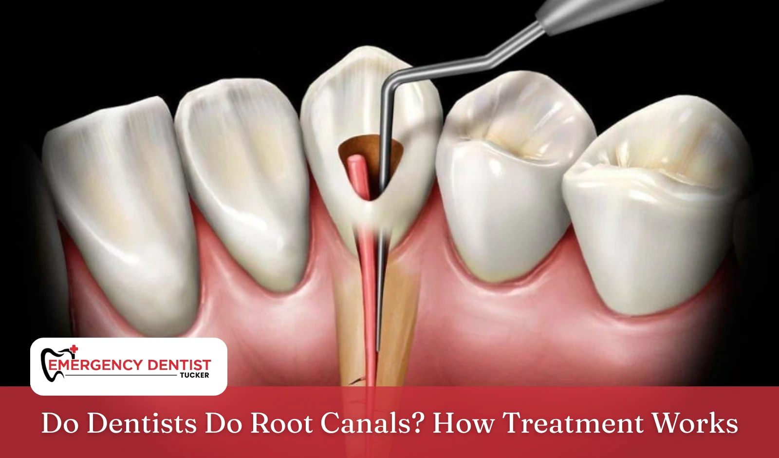 do-dentists-do-root-canals