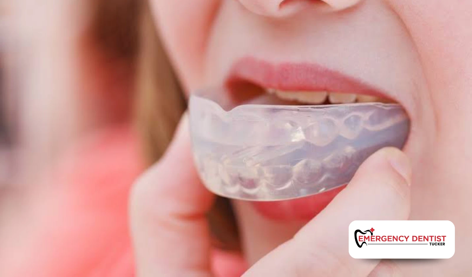 How Mouthguards Help Protect the Teeth